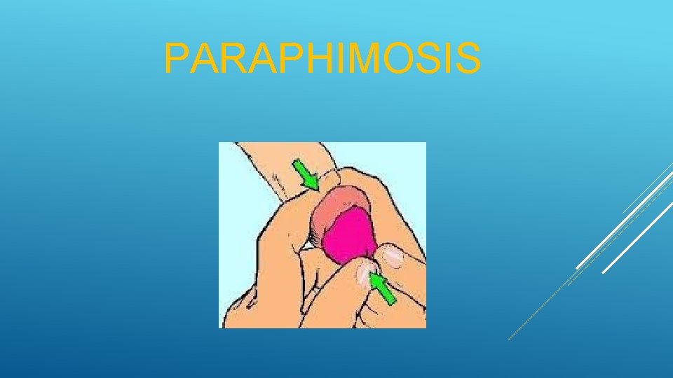 PARAPHIMOSIS 