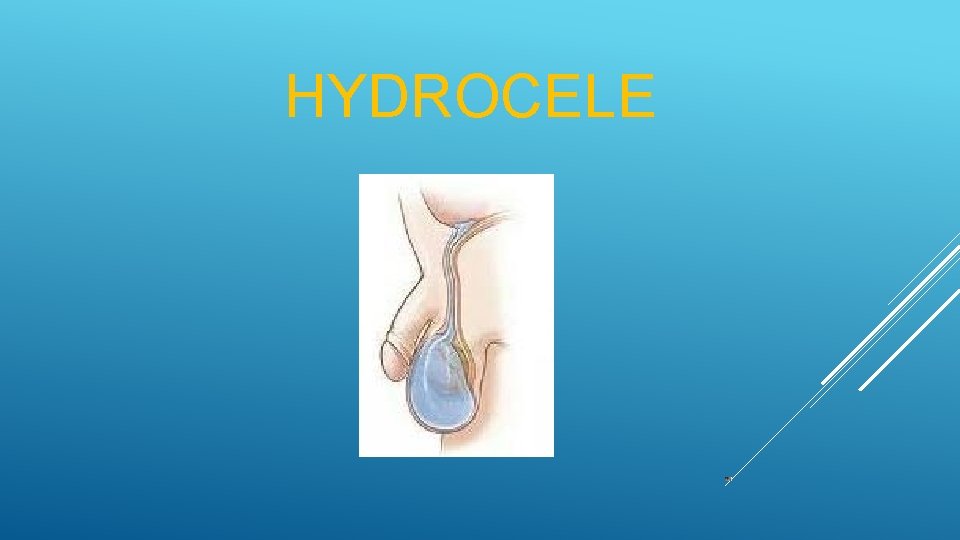 HYDROCELE 