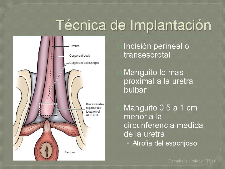 Técnica de Implantación � Incisión perineal o transescrotal � Manguito lo mas proximal a