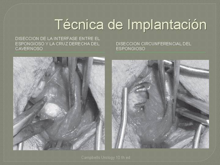 Técnica de Implantación DISECCION DE LA INTERFASE ENTRE EL ESPONGIOSO Y LA CRUZ DERECHA