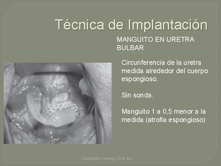 Técnica de Implantación MANGUITO EN URETRA BULBAR � Circunferencia de la uretra medida alrededor