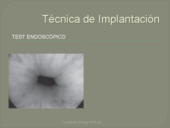Técnica de Implantación TEST ENDOSCÓPICO Campbells Urology 10 th ed 