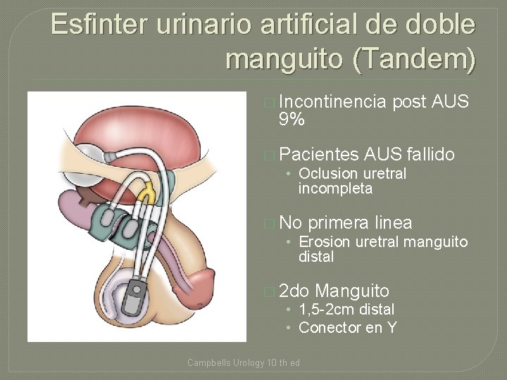 Esfinter urinario artificial de doble manguito (Tandem) � Incontinencia 9% � Pacientes post AUS