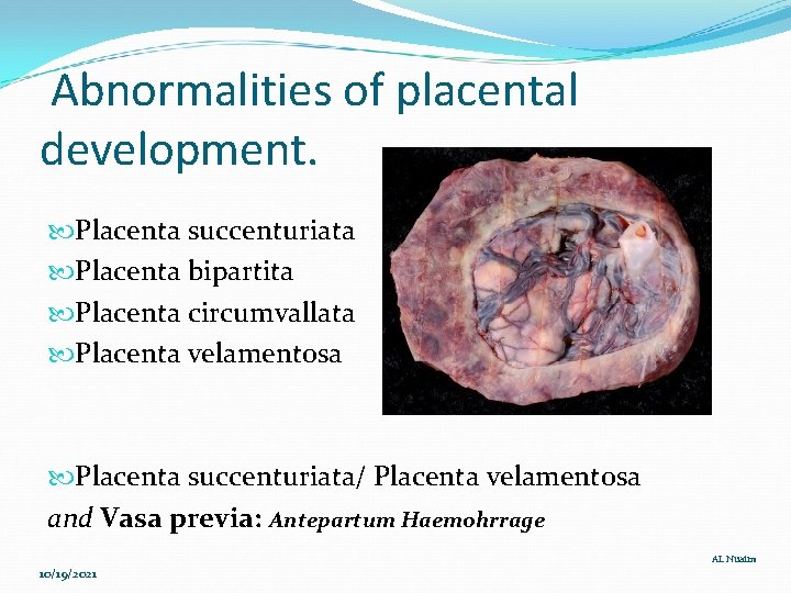 Abnormalities of placental development. Placenta succenturiata Placenta bipartita Placenta circumvallata Placenta velamentosa Placenta succenturiata/