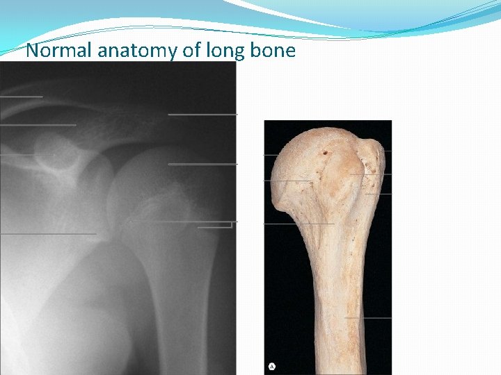 Normal anatomy of long bone 