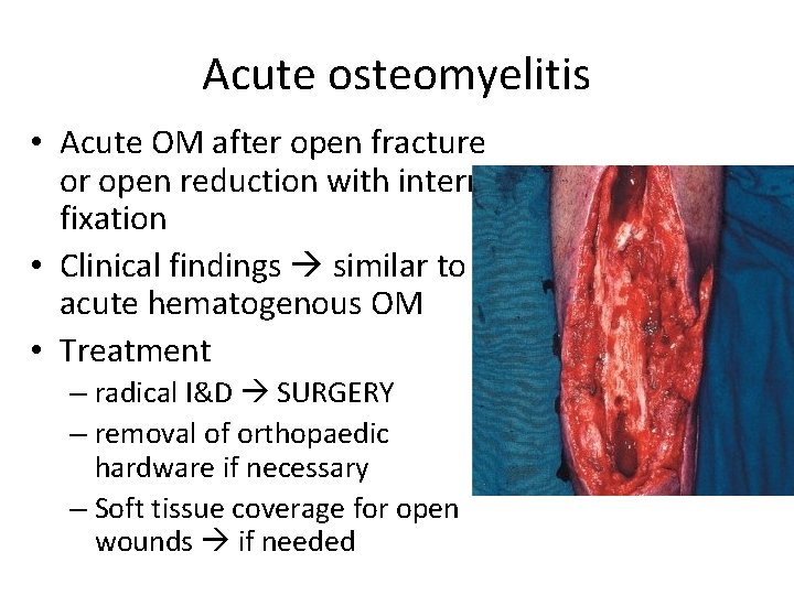 Acute osteomyelitis • Acute OM after open fracture or open reduction with internal fixation