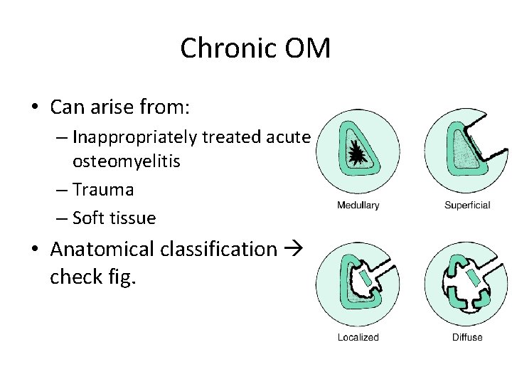 Chronic OM • Can arise from: – Inappropriately treated acute osteomyelitis – Trauma –