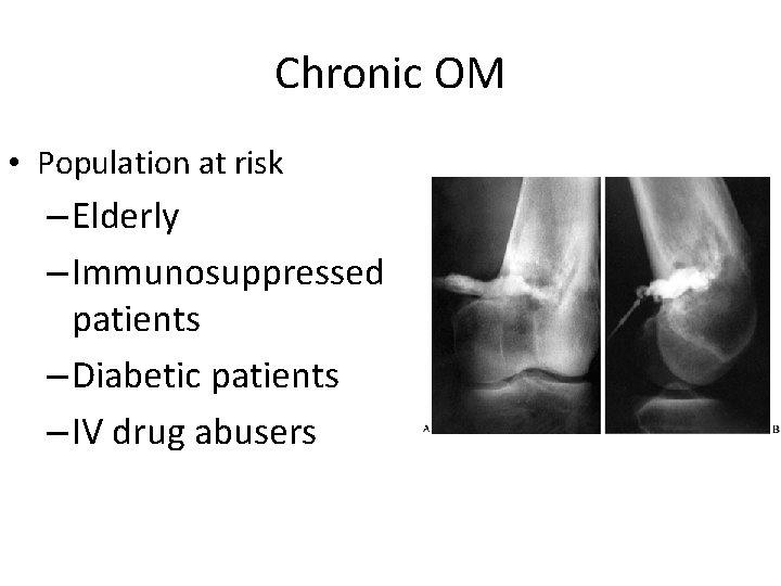 Chronic OM • Population at risk – Elderly – Immunosuppressed patients – Diabetic patients