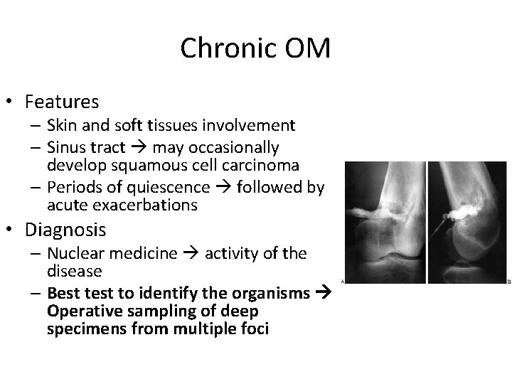 Chronic OM • Features – Skin and soft tissues involvement – Sinus tract may