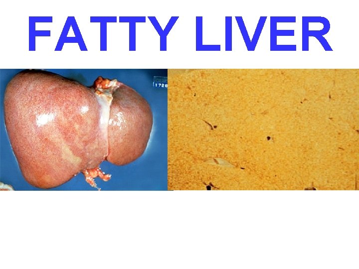 FATTY LIVER 