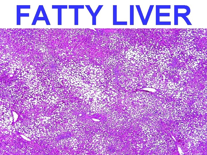FATTY LIVER 