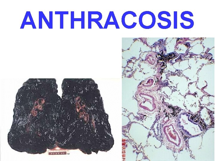 ANTHRACOSIS 