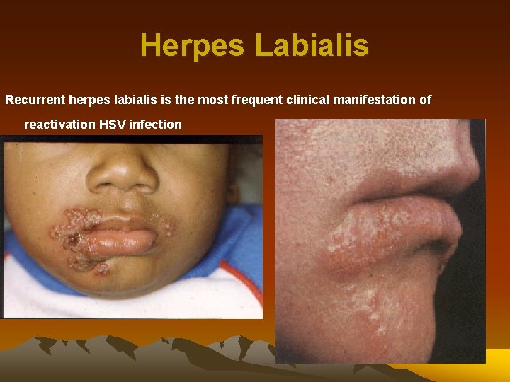 Herpes Labialis Recurrent herpes labialis is the most frequent clinical manifestation of reactivation HSV