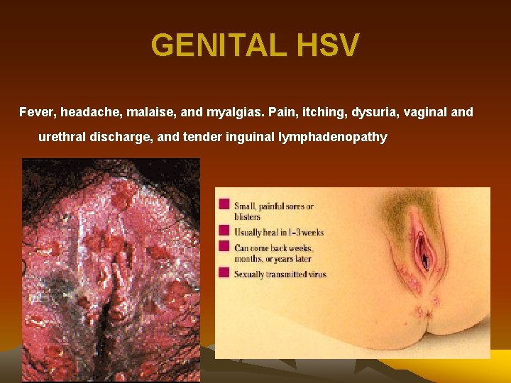 GENITAL HSV Fever, headache, malaise, and myalgias. Pain, itching, dysuria, vaginal and urethral discharge,