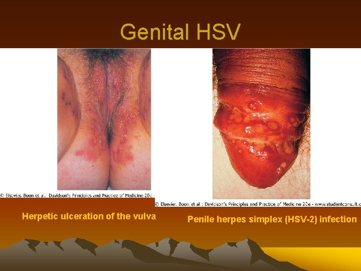 Genital HSV Herpetic ulceration of the vulva Penile herpes simplex (HSV-2) infection 