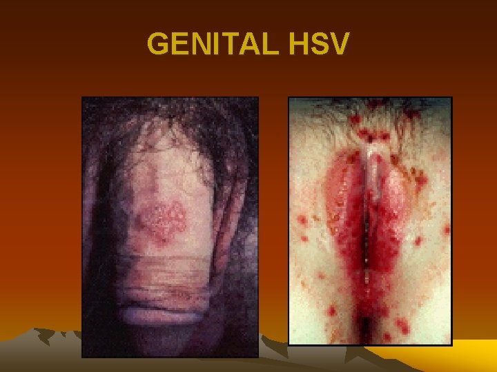 GENITAL HSV 