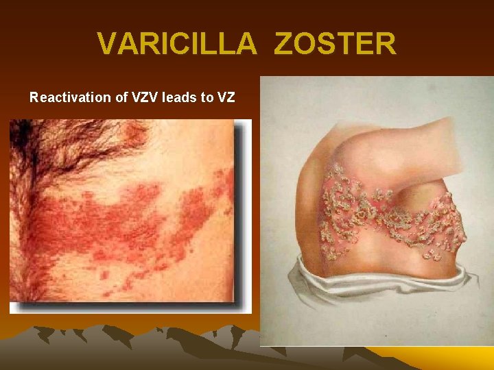 VARICILLA ZOSTER Reactivation of VZV leads to VZ 
