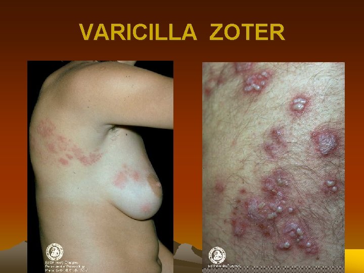 VARICILLA ZOTER 
