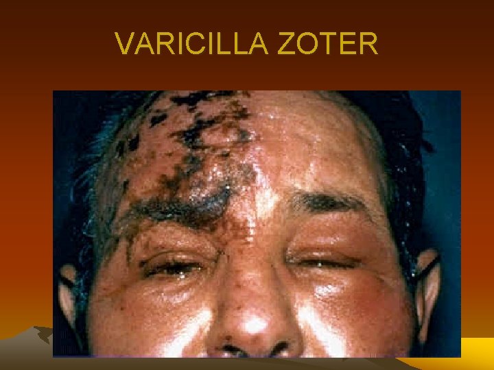 VARICILLA ZOTER 