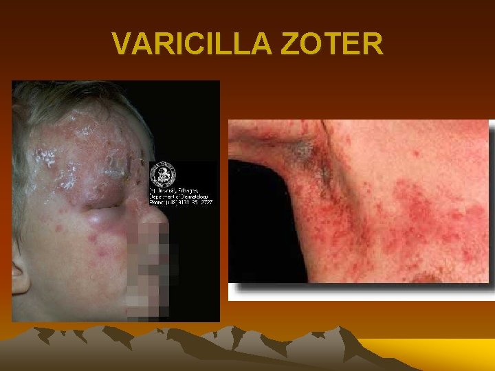 VARICILLA ZOTER 