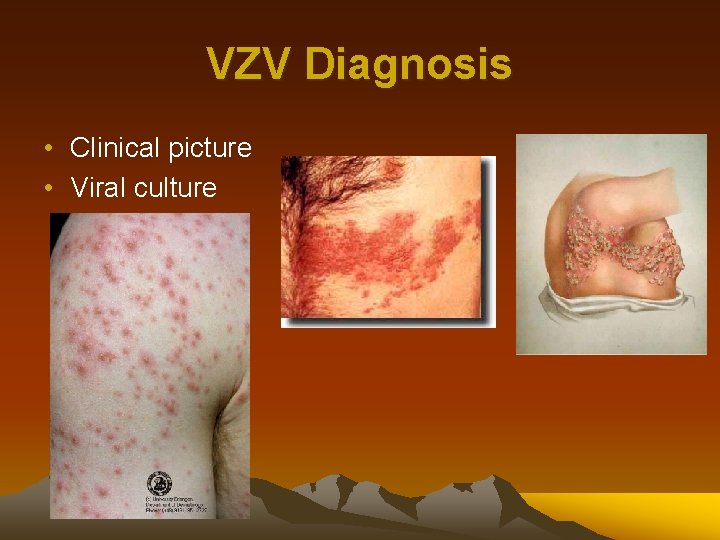 VZV Diagnosis • Clinical picture • Viral culture 