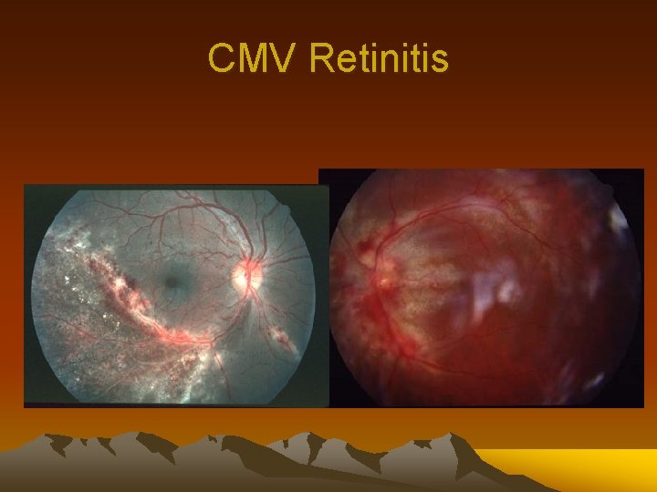 CMV Retinitis 