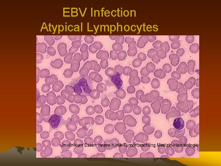 EBV Infection Atypical Lymphocytes 