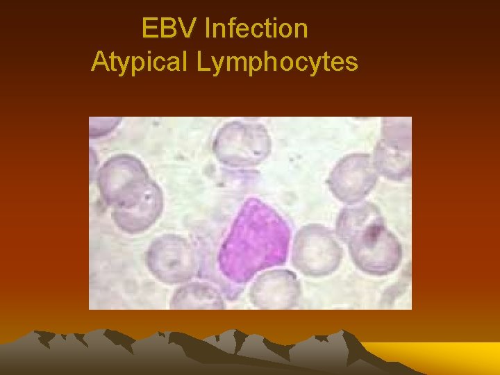 EBV Infection Atypical Lymphocytes 