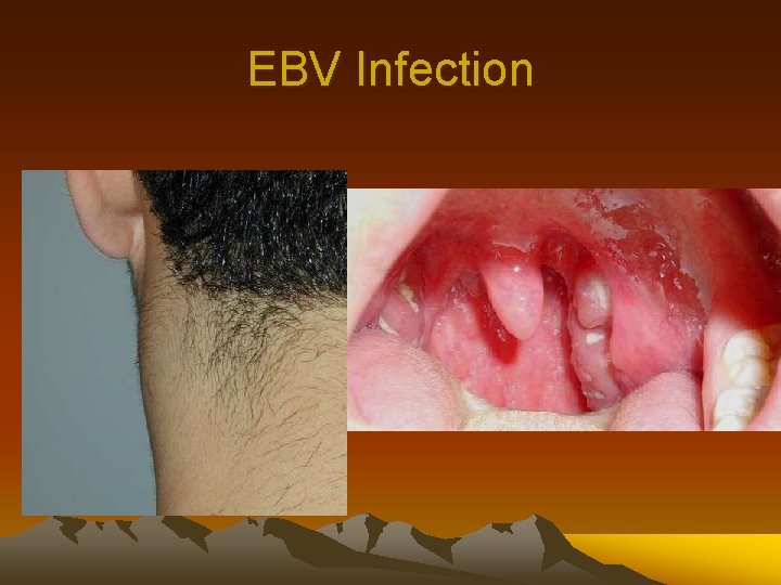 EBV Infection 