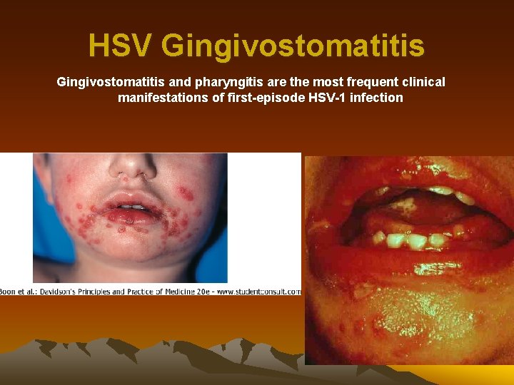 HSV Gingivostomatitis and pharyngitis are the most frequent clinical manifestations of first-episode HSV-1 infection