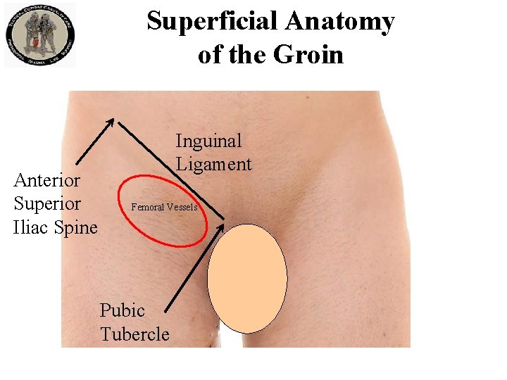 Superficial Anatomy of the Groin Anterior Superior Iliac Spine Inguinal Ligament Femoral Vessels Pubic