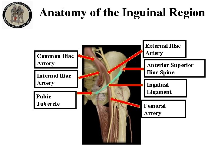 Anatomy of the Inguinal Region Common Iliac Artery Internal Iliac Artery Pubic Tubercle External