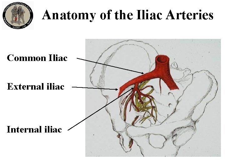 Anatomy of the Iliac Arteries Common Iliac External iliac Internal iliac 