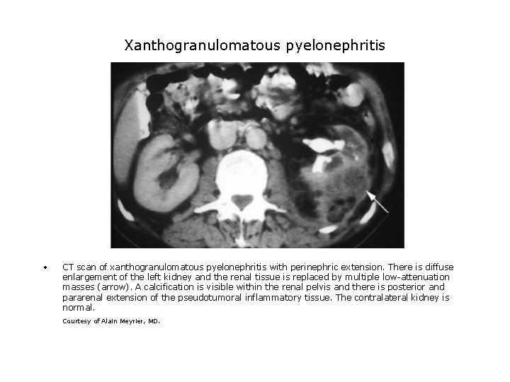 Xanthogranulomatous pyelonephritis • CT scan of xanthogranulomatous pyelonephritis with perinephric extension. There is diffuse