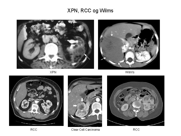 XPN, RCC og Wilms XPN RCC Wilm’s Clear Cell Carcinoma RCC 