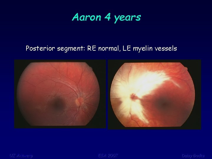 Aaron 4 years Posterior segment: RE normal, LE myelin vessels UZ Antwerp ESA 2007