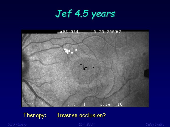 Jef 4. 5 years Therapy: UZ Antwerp Inverse occlusion? ESA 2007 Daisy Godts 