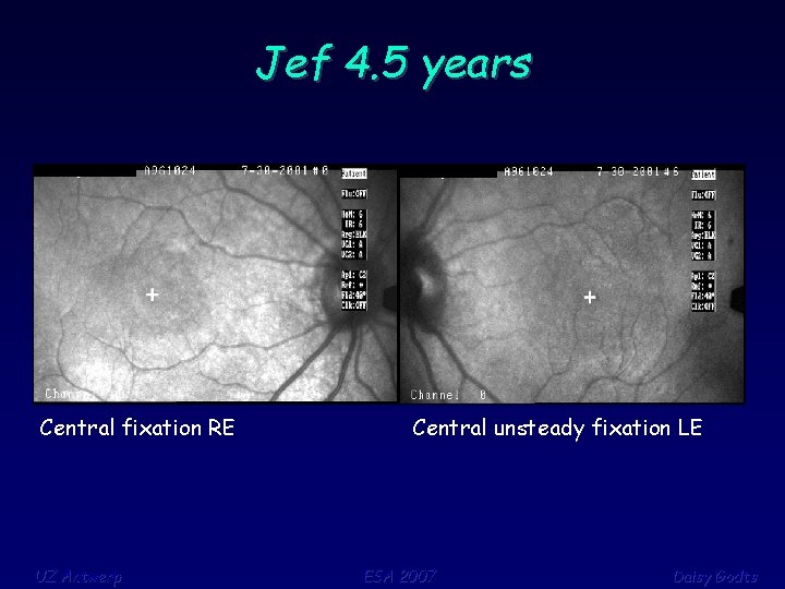 Jef 4. 5 years Central fixation RE UZ Antwerp Central unsteady fixation LE ESA