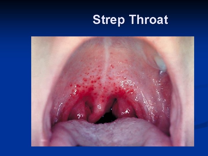 Strep Throat 