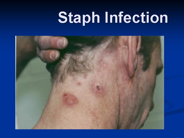 Staph Infection 