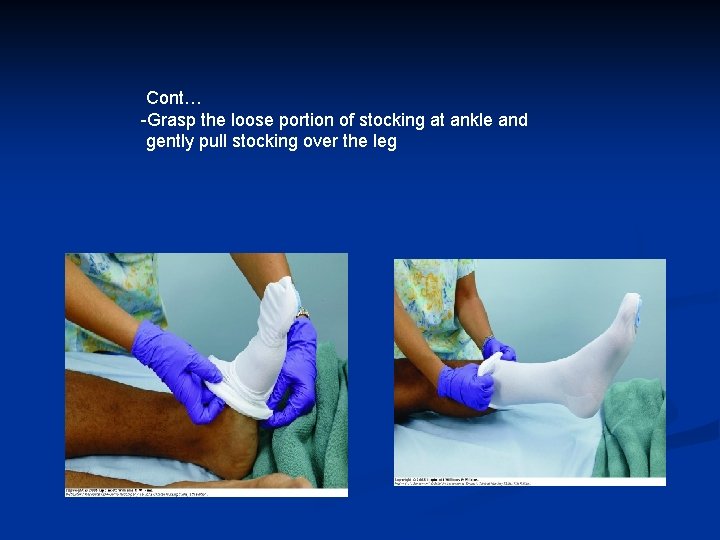 Cont… -Grasp the loose portion of stocking at ankle and gently pull stocking over