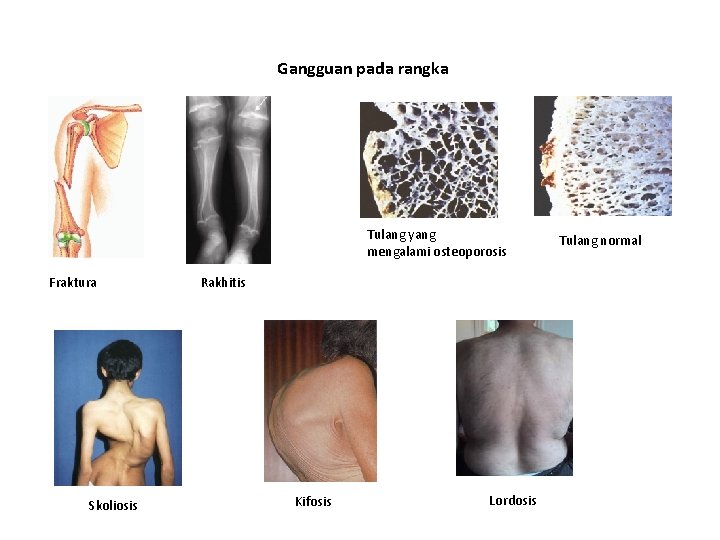 Gangguan pada rangka Tulang yang mengalami osteoporosis Fraktura Skoliosis Rakhitis Kifosis Lordosis Tulang normal