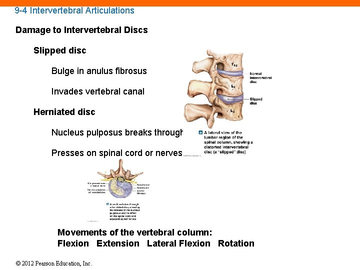 9 -4 Intervertebral Articulations Damage to Intervertebral Discs Slipped disc Bulge in anulus fibrosus
