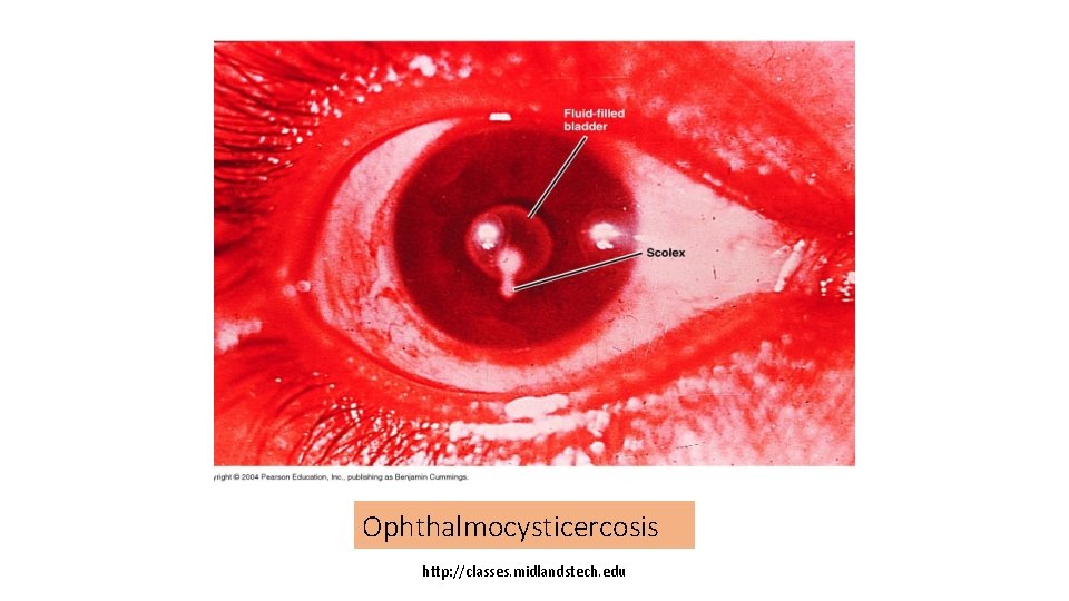 Ophthalmocysticercosis http: //classes. midlandstech. edu 