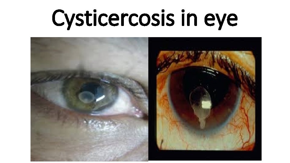 Cysticercosis in eye Cysticercosis in eye