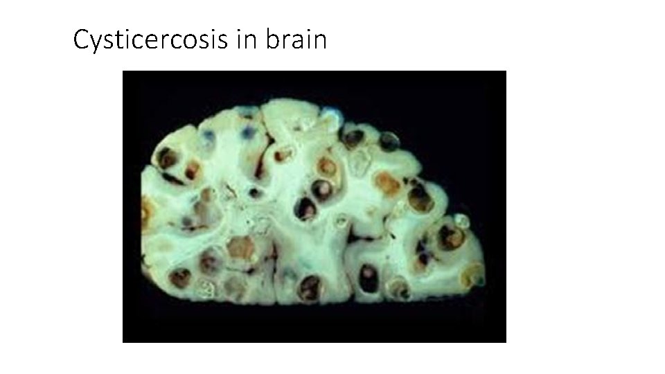 Cysticercosis in brain Cysticercosis in brain