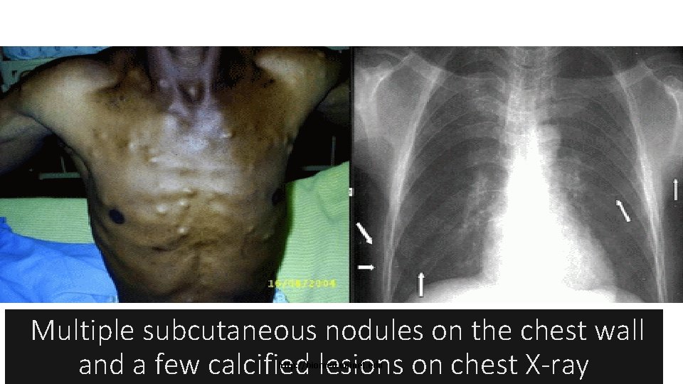 Multiple subcutaneous nodules on the chest wall and a few calcified lesions on chest