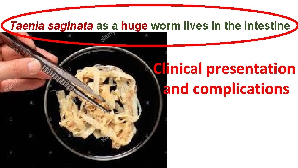Taenia saginata as a huge worm lives in the intestine Clinical presentation and complications