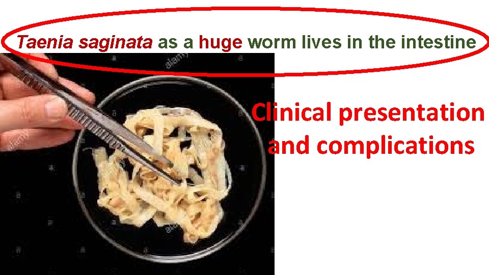 Taenia saginata as a huge worm lives in the intestine Clinical presentation and complications Taenia saginata as a huge worm lives in the intestine Clinical presentation and complications