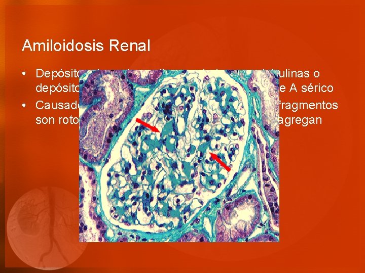 Amiloidosis Renal • Depósitos de cadenas ligeras de inmunoglobulinas o depósitos fibrilares de fragmentos